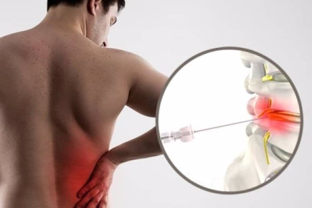 fisioterapia para hernia